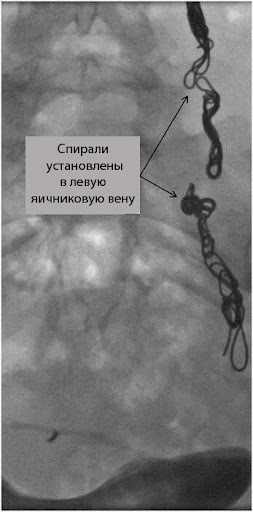 Эмболизация яичниковой вены