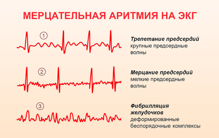 mercatelnaya-aritmiya-na-ekg.jpg