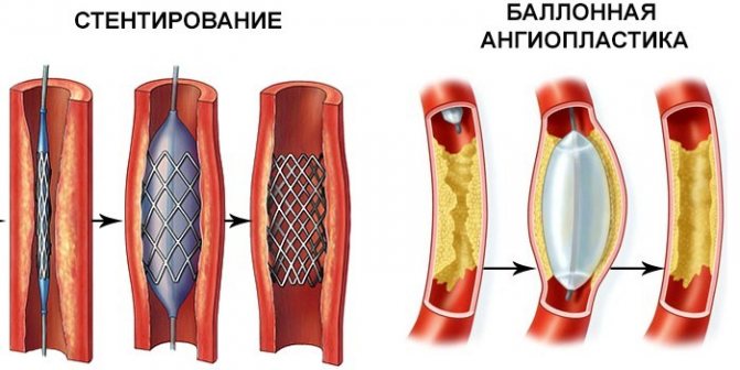 stentirovanie-i-ballonnaya-angioplastika.jpg