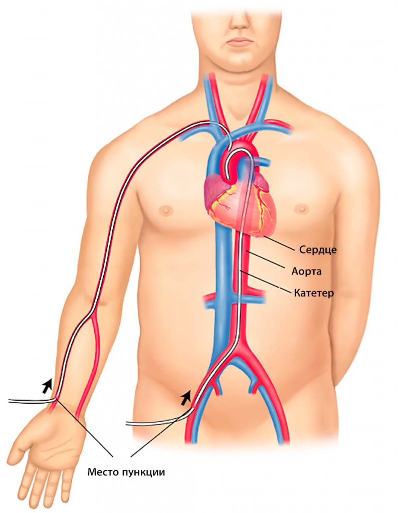 коронарография пункция