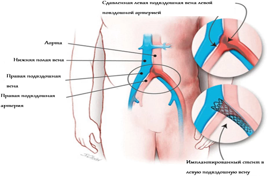 •	Стентирование подвздошной вены