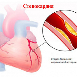 Стенокардия. Причины, диагностика и лечение.